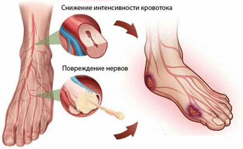 Атеросклероз сосудов ног