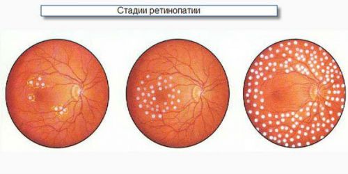 Стадии диабетической ретинопатии